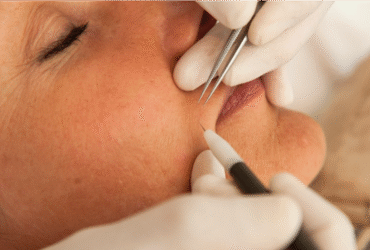 Électrolyse définitive : le secret d’une peau parfaitement lisse