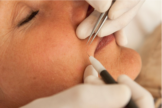 Électrolyse définitive : le secret d’une peau parfaitement lisse